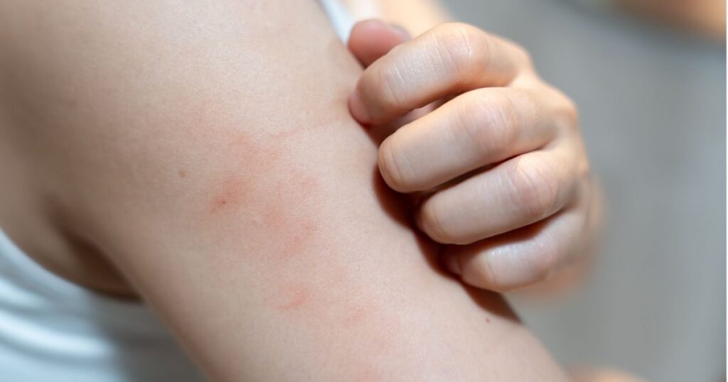 Brazo con rojeces y una mano rascando la piel irritada.