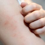 Brazo con rojeces y una mano rascando la piel irritada.